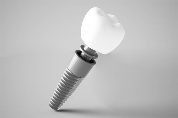 Dental Implant